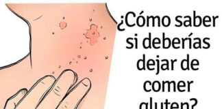 Intolerancia al gluten