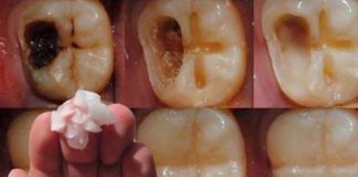 caries