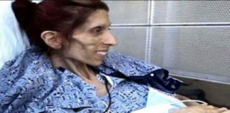 ANOREXIA